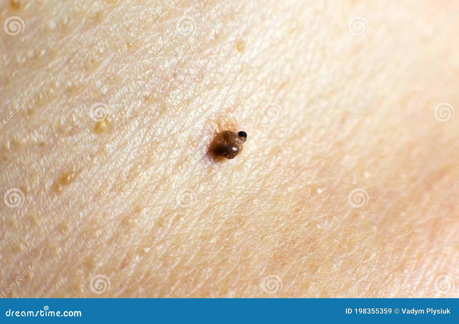 Gran Marca De Nacimiento En La Piel. Foto Médica. Papilomas Sobre El