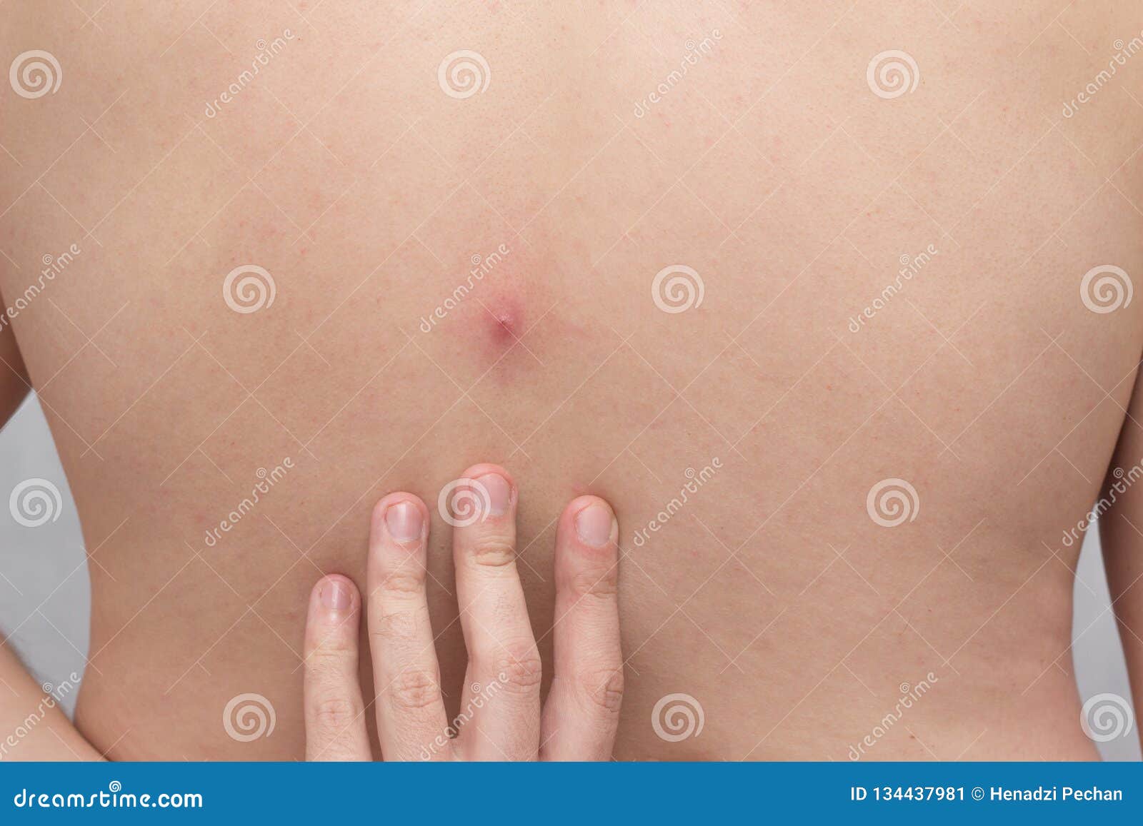 Grand Bouton Rouge Sur Le Dos D'un Homme, Abcès, En Gros Plan, Médical,  Pustule Image stock - Image du hommes, doigts: 134437981