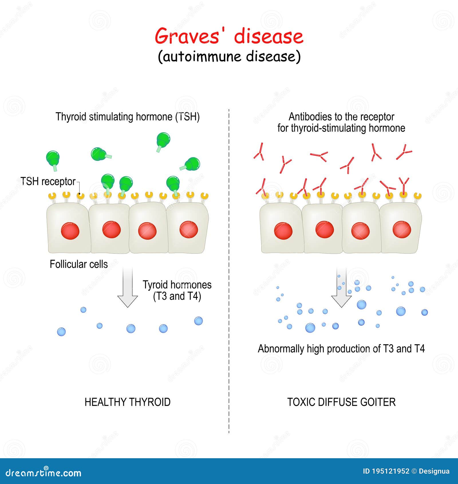 graves` disease. autoimmune disorder