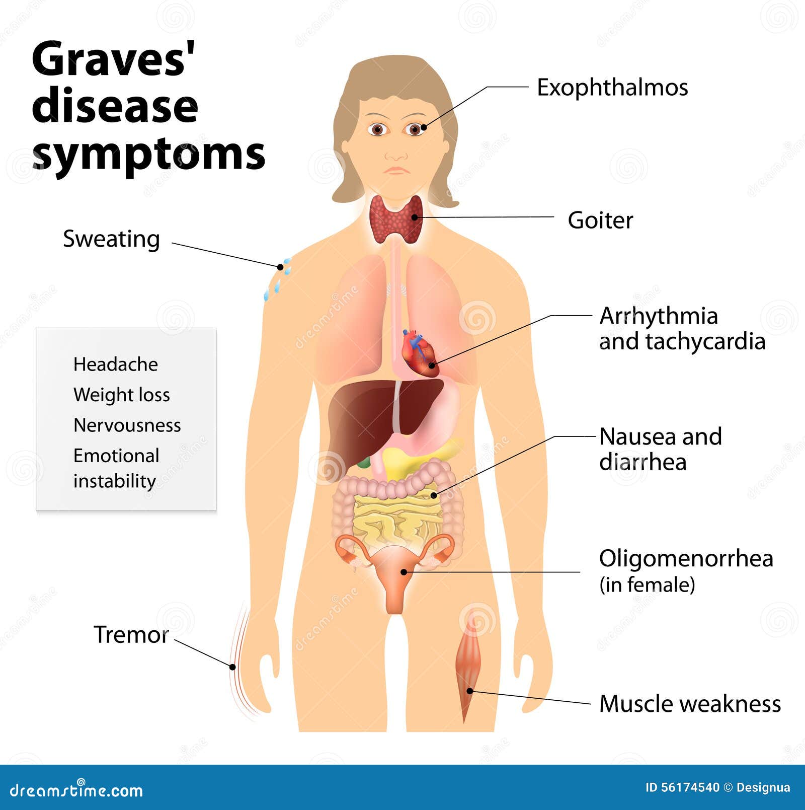 graves' disease or basedow disease. symptoms and signs