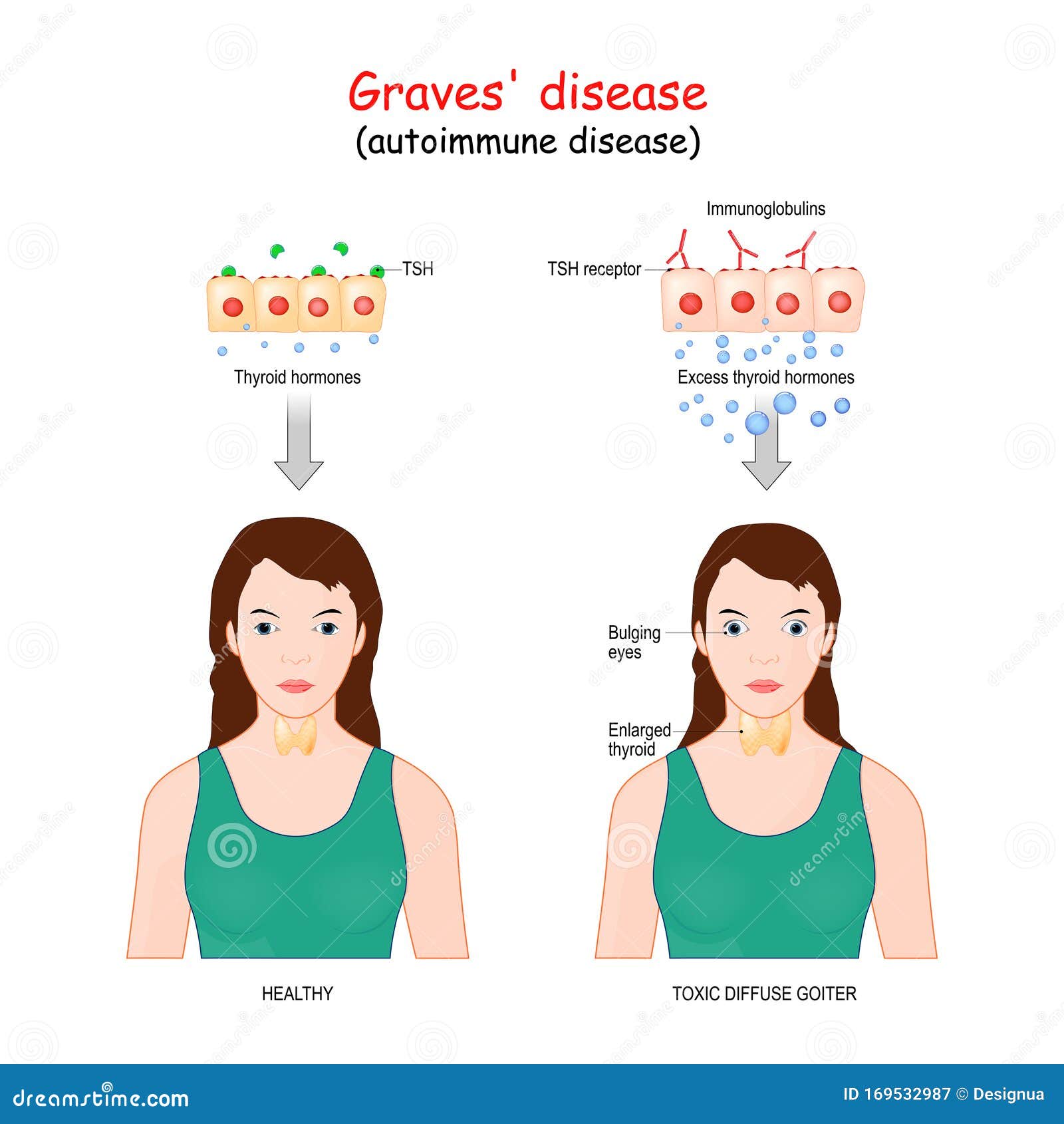 graves` disease. toxic diffuse goiter is an autoimmune disease that affects the thyroid