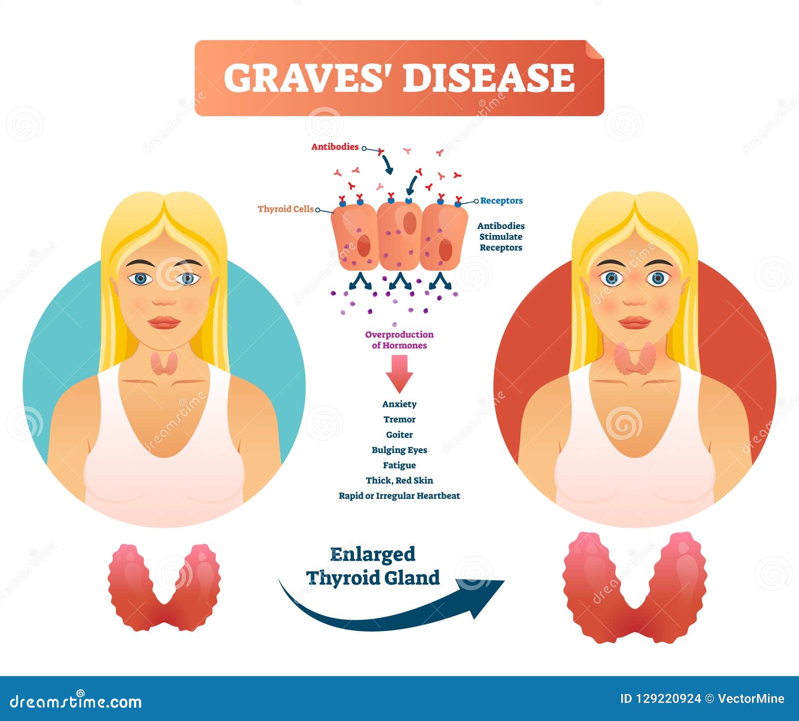 graves disease  . labeled diagnosis symptoms diagram