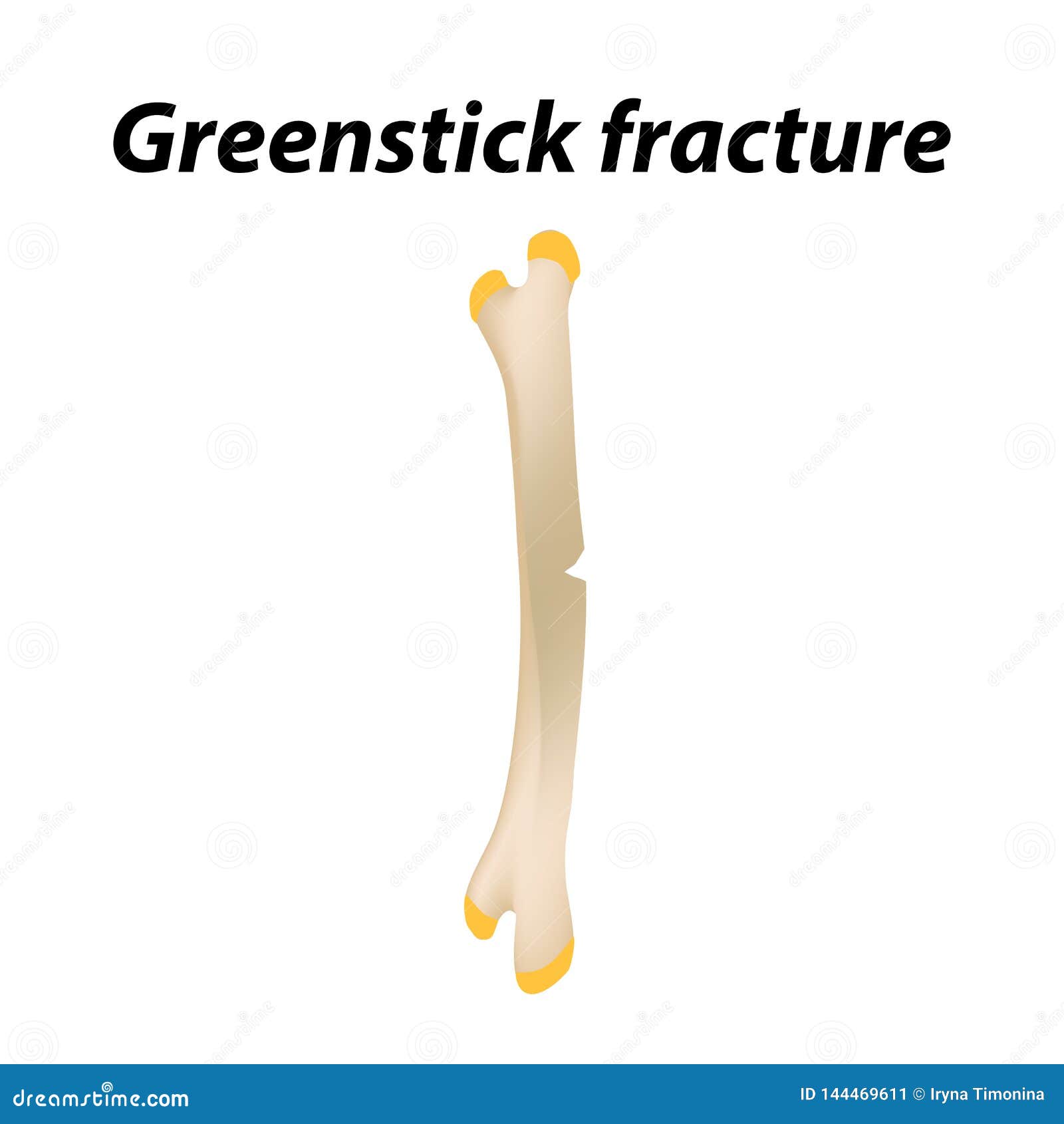 Greenstick Fracture Bone. Infographics. Vector Illustration On A Lined