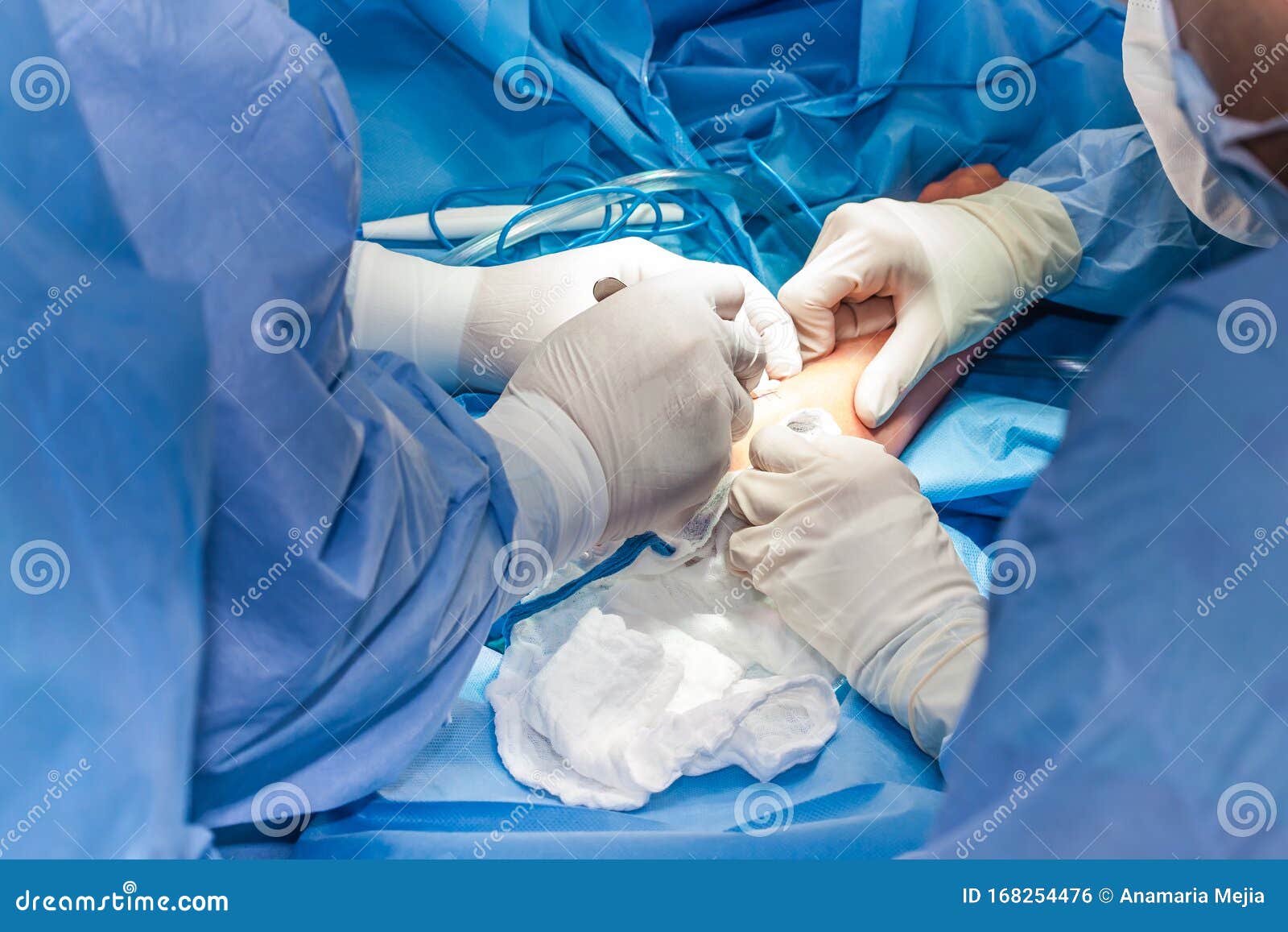 Group of Surgeons Performing an Elbow Surgery Stock Photo Image of