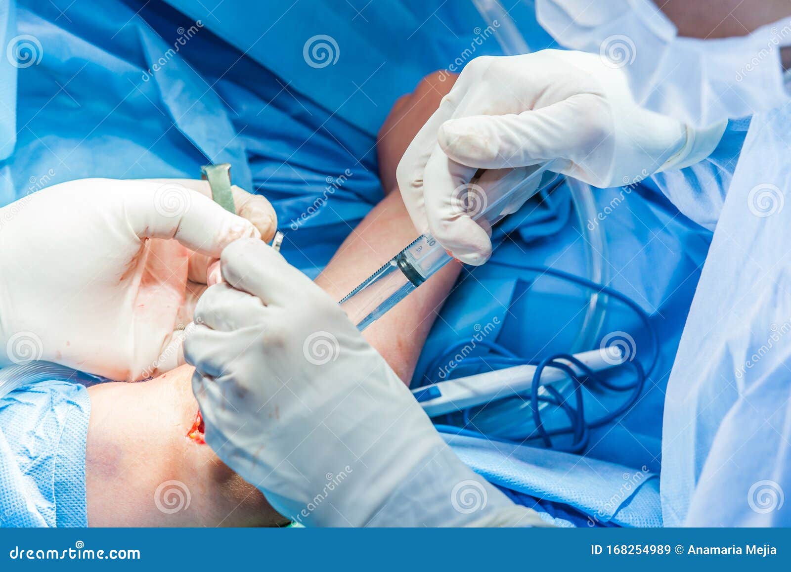Group of Surgeons Performing an Elbow Surgery Stock Image Image of