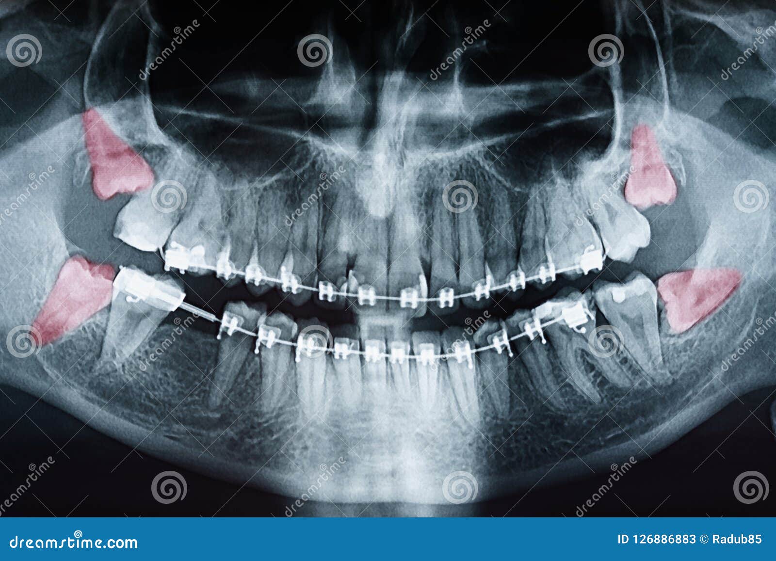 growing wisdom teeth pain on x-ray