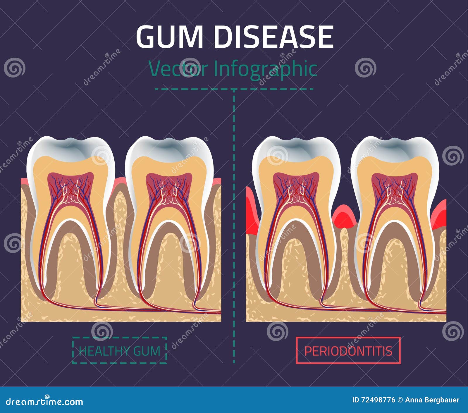 Periodontal Disease Chart