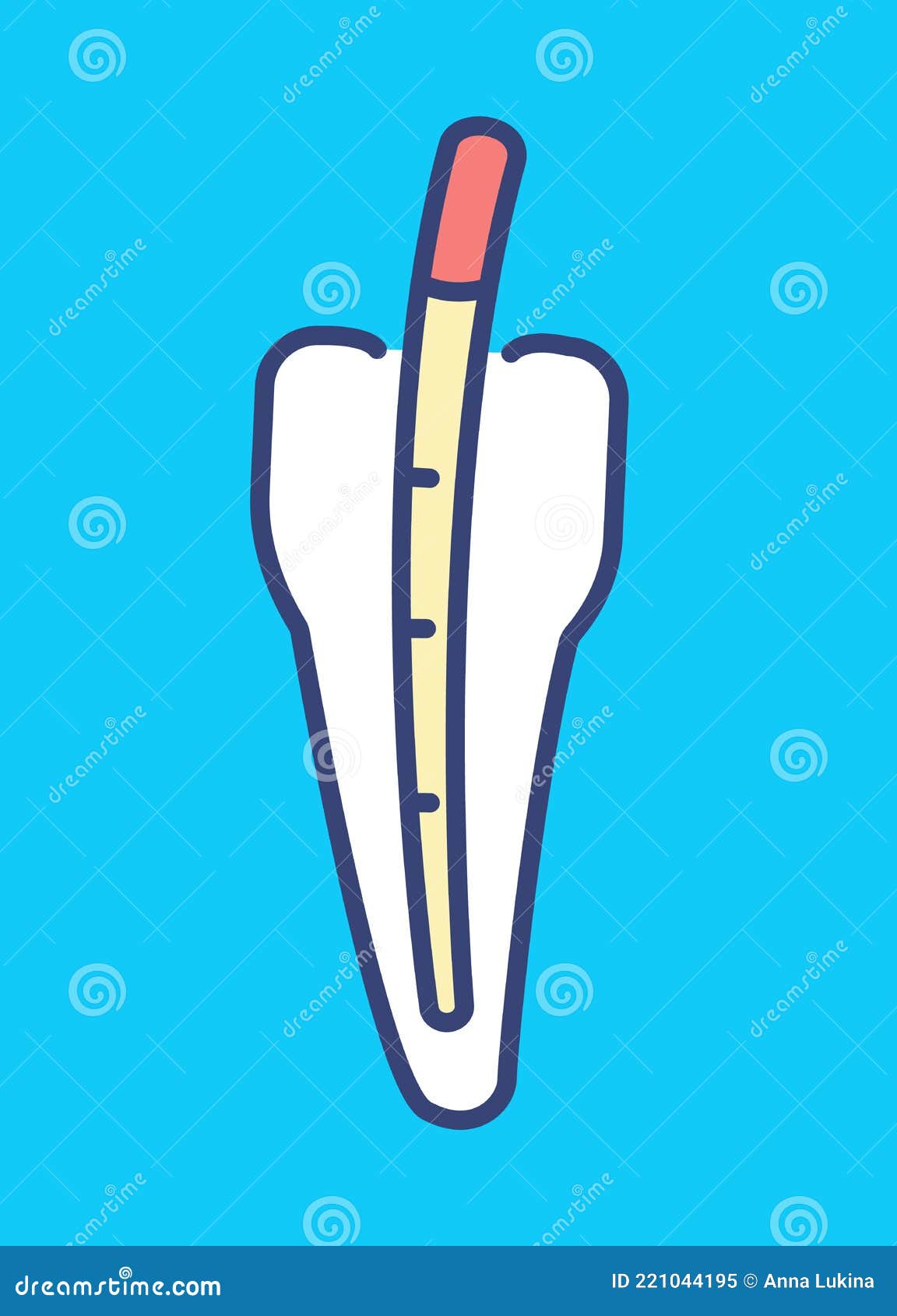 Guttapercha Pins in Tooth. Root Canal Filling. Modern Material for