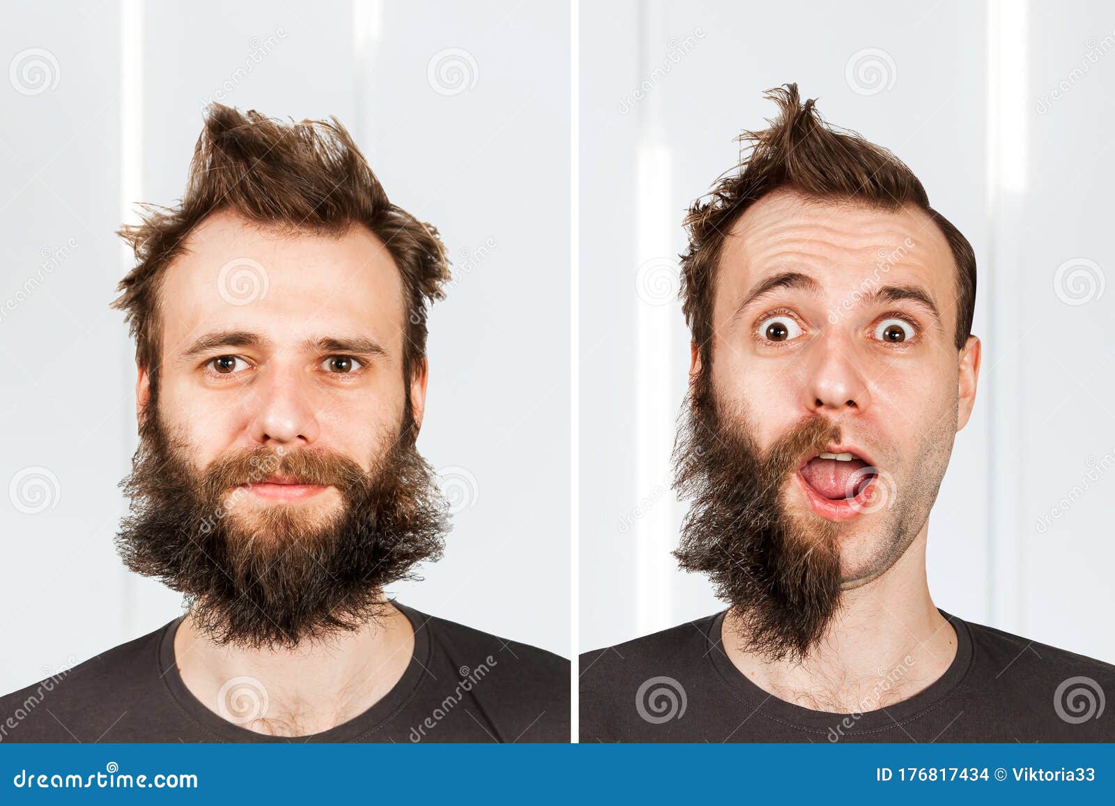 Guy With Half Beard And Without Hair Loss Man Before And After Shave Or Transplant Haircut Set Transformation Stock Photo Image Of Amazed Bald