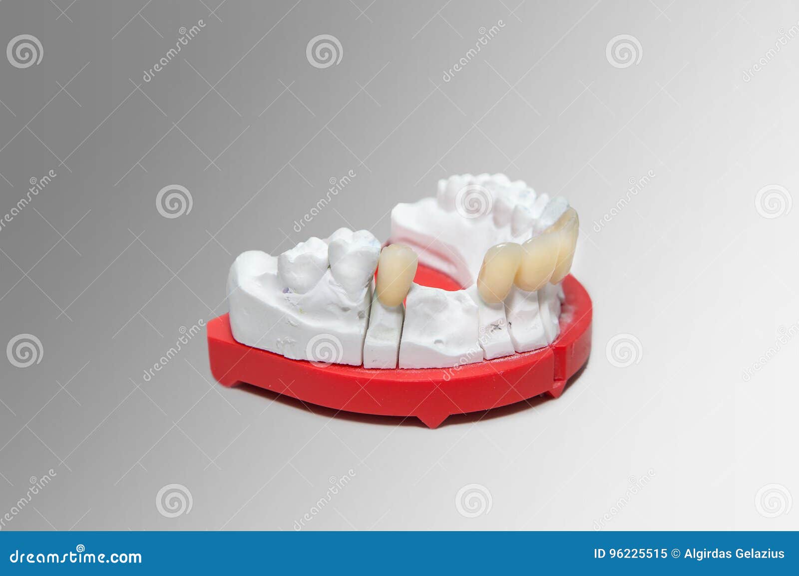 Gypsum Dental Model with Ceramic Teeth Stock Image Image of medicine