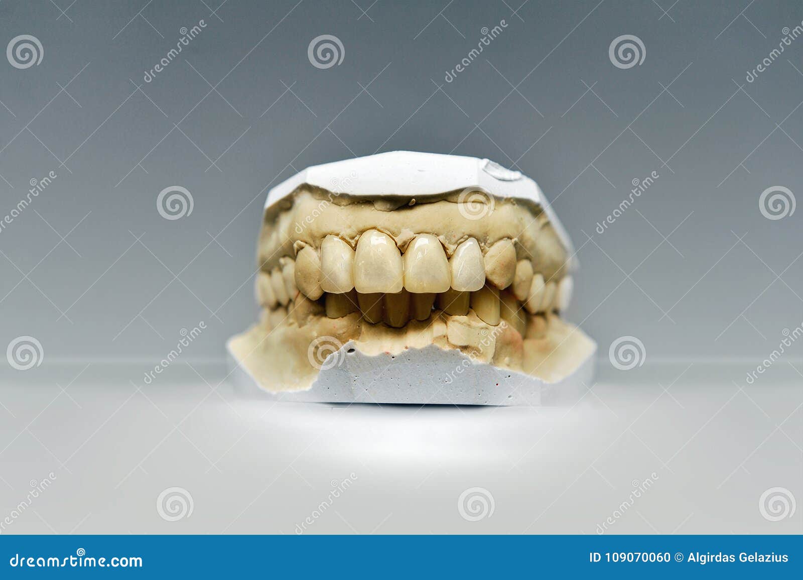 Gypsum Dental Model with Four Ceramic Teeth Stock Photo Image of