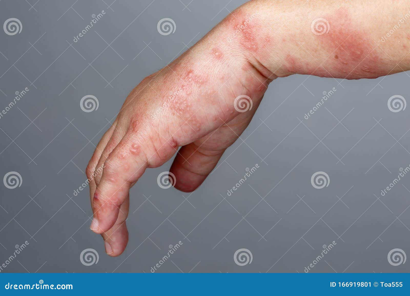 Kleinkind herpes am arm