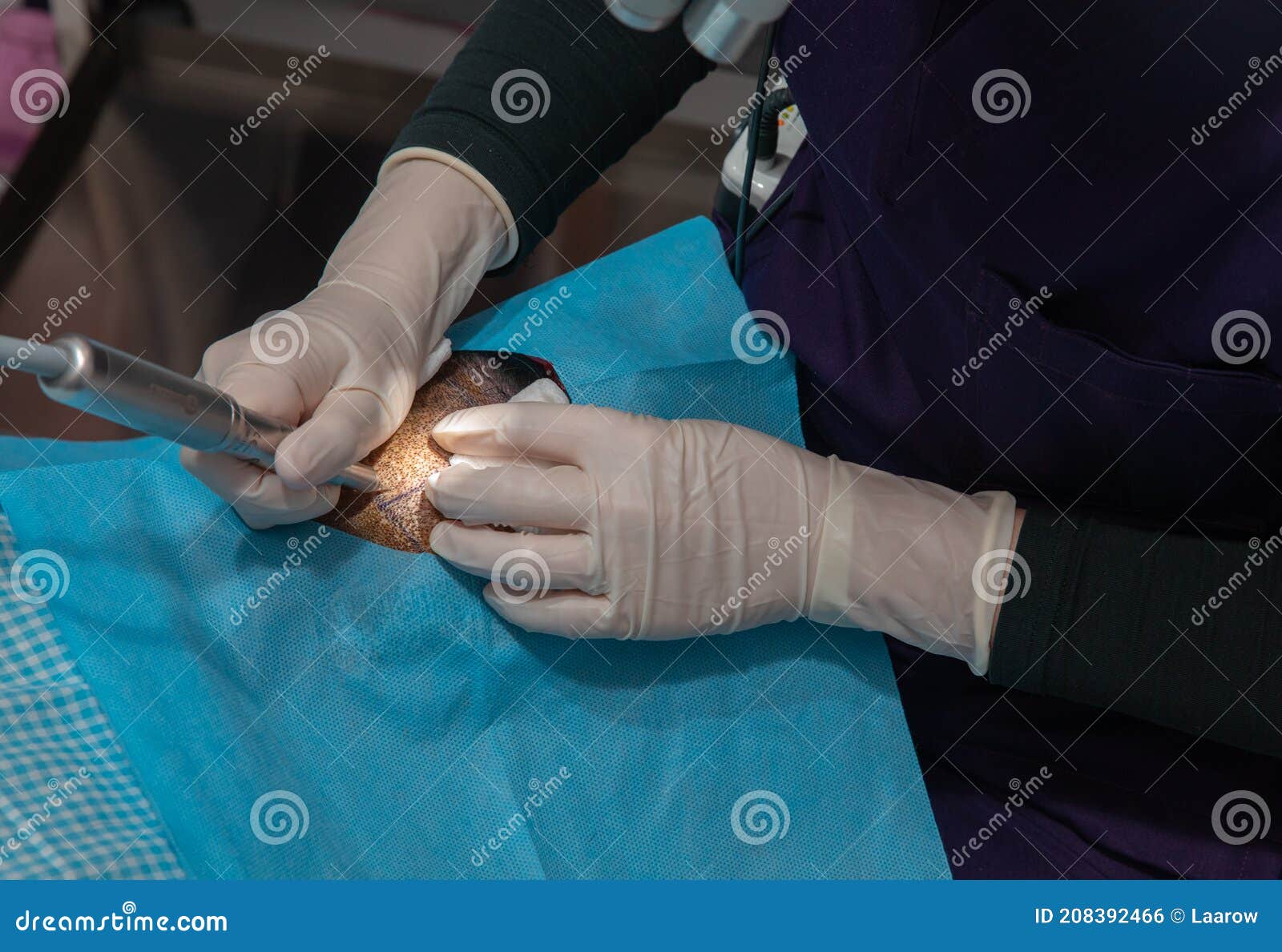 Hair Implant Process, Collecting Hair Plasma for Implanting Process