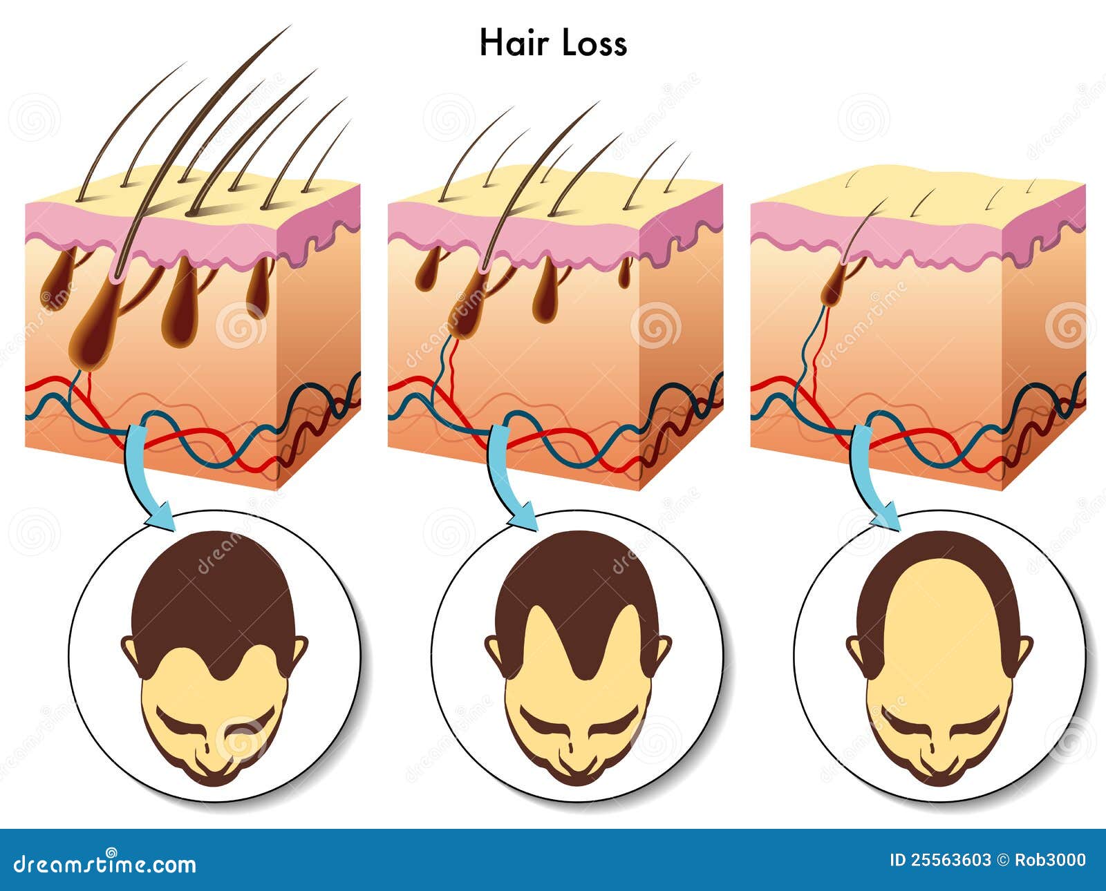 hair loss