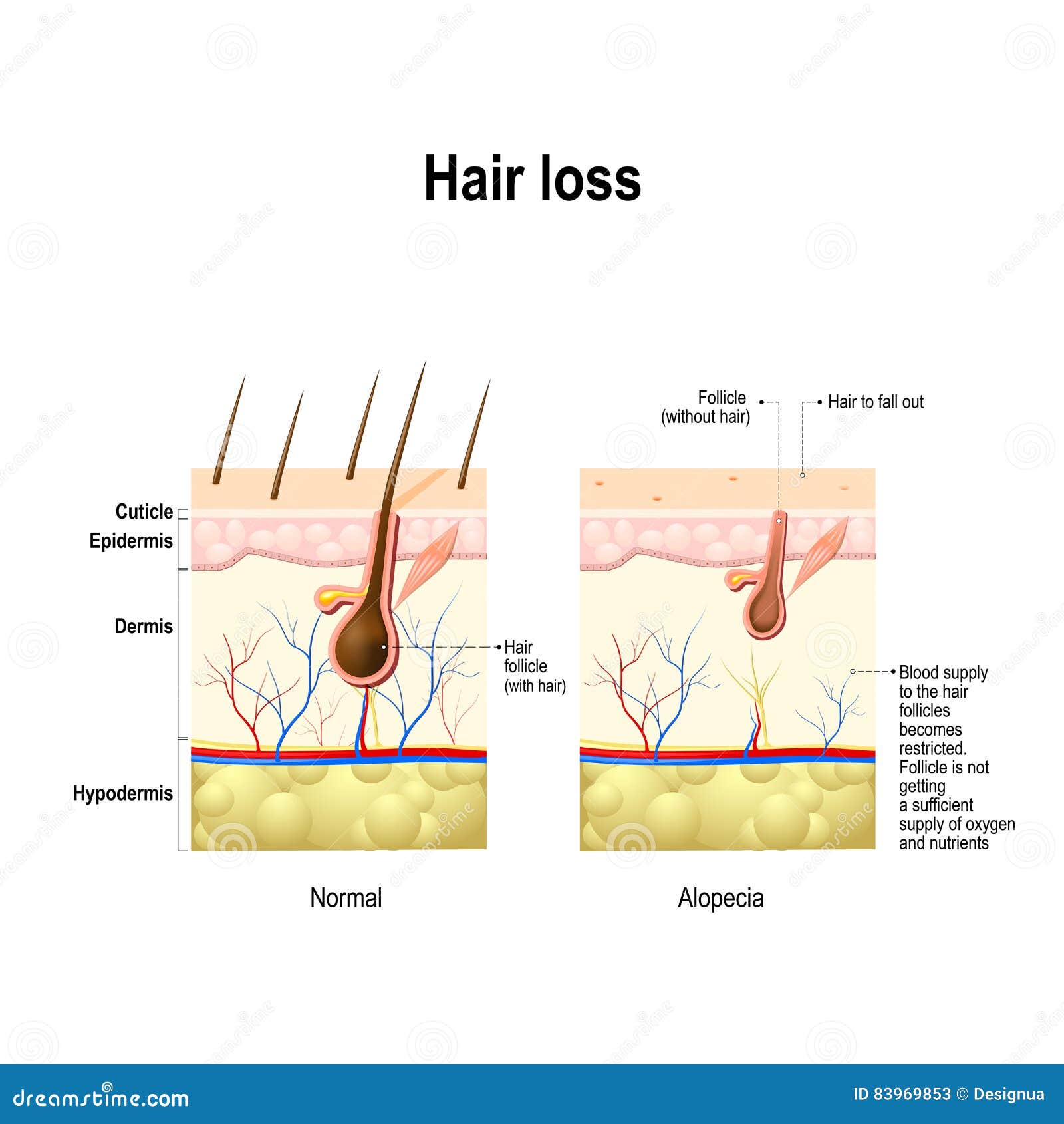 hair loss, alopecia, baldness