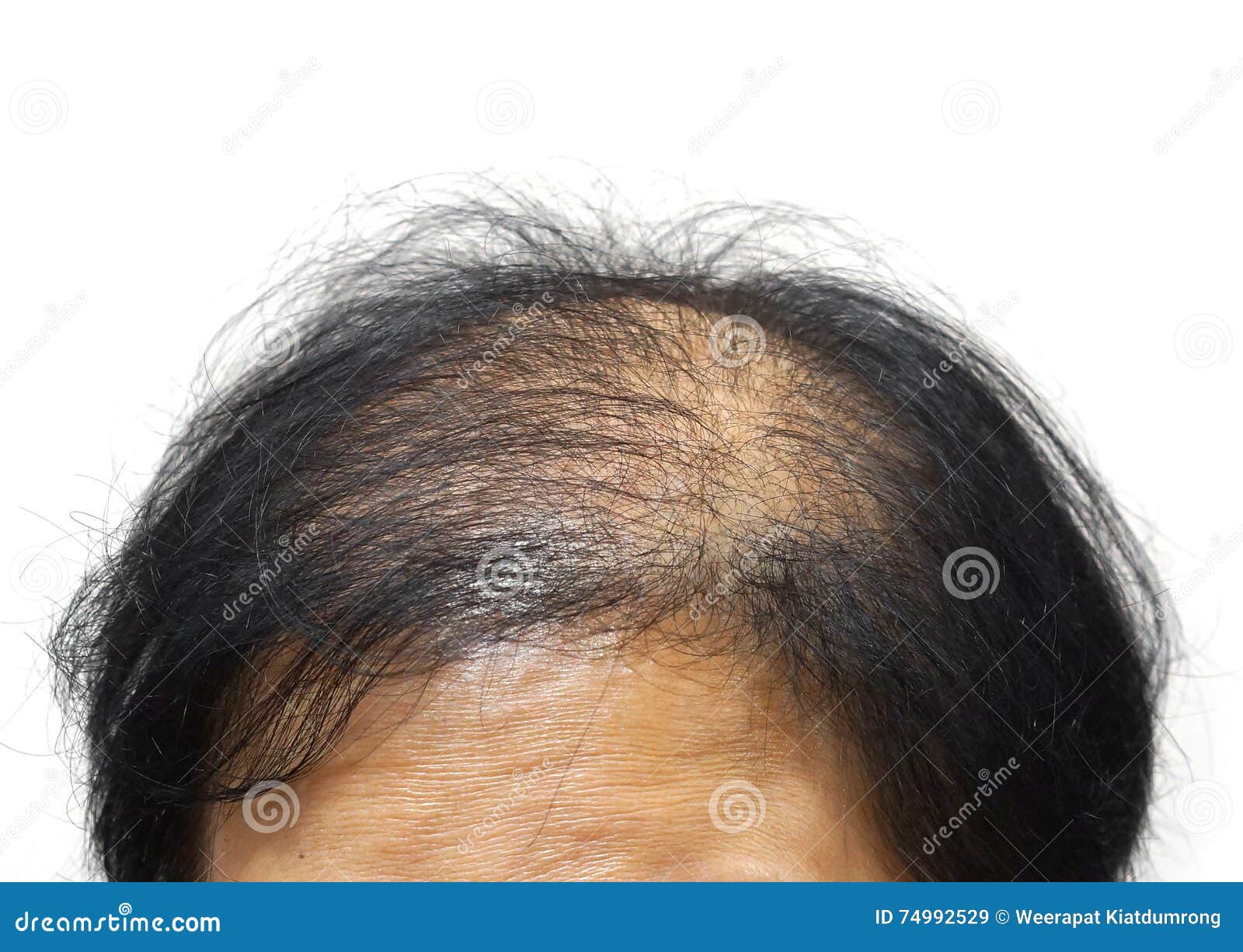 Hair Loss stock image. Image of isolated, alopecia, effect - 74992529