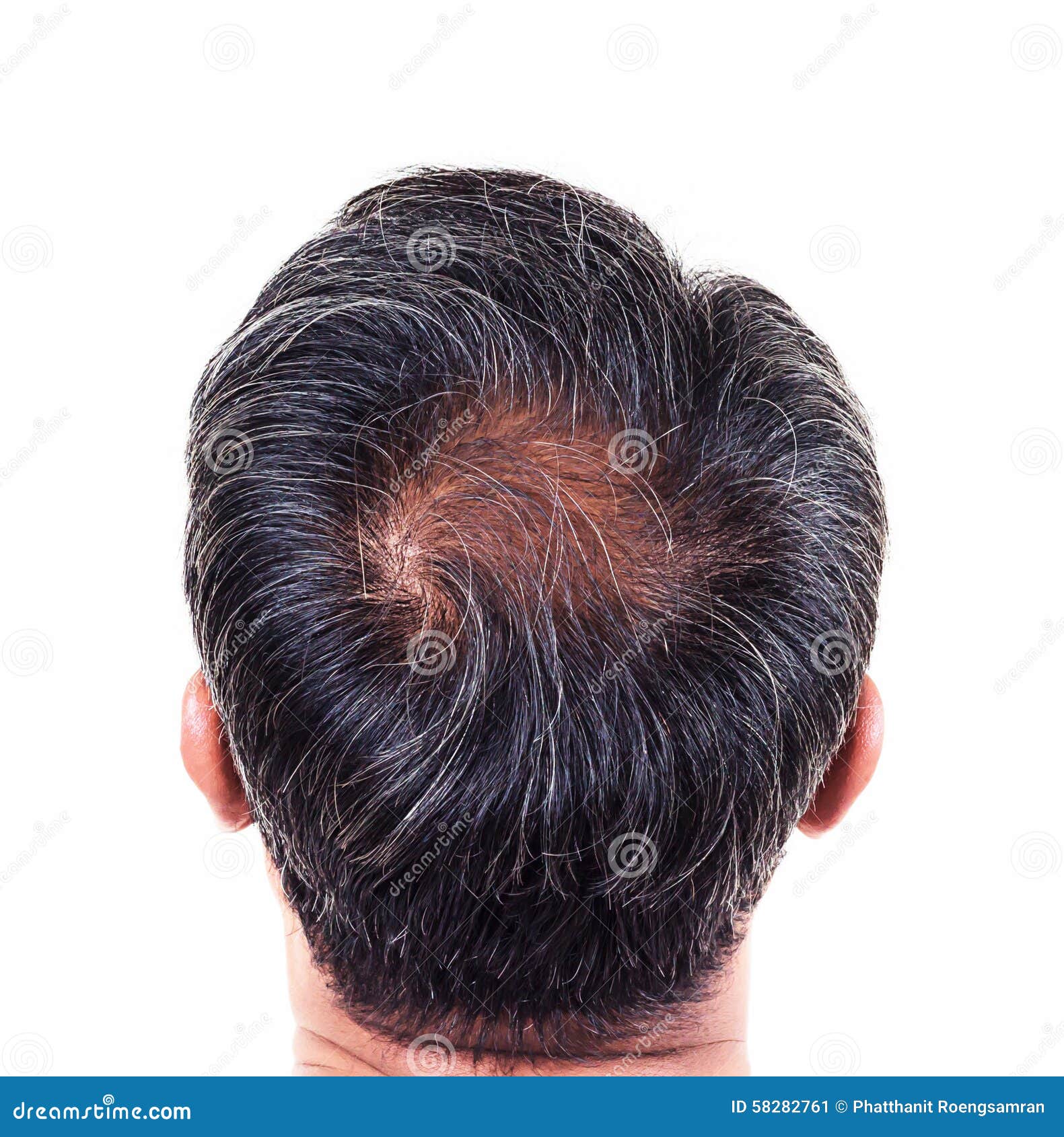 hair loss and grey hair, Male head with hair loss symptoms Stock Photo -  Alamy