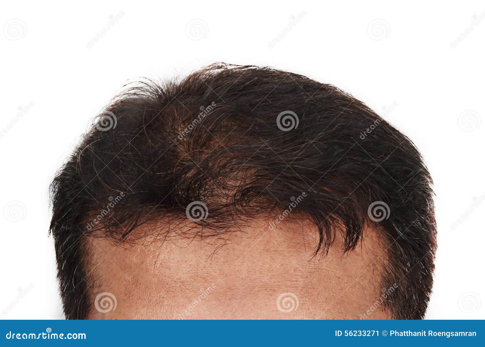 Hair Loss, Male Head with Hair Loss Symptoms Front Side Stock Image - Image  of health, hairstyle: 56233271