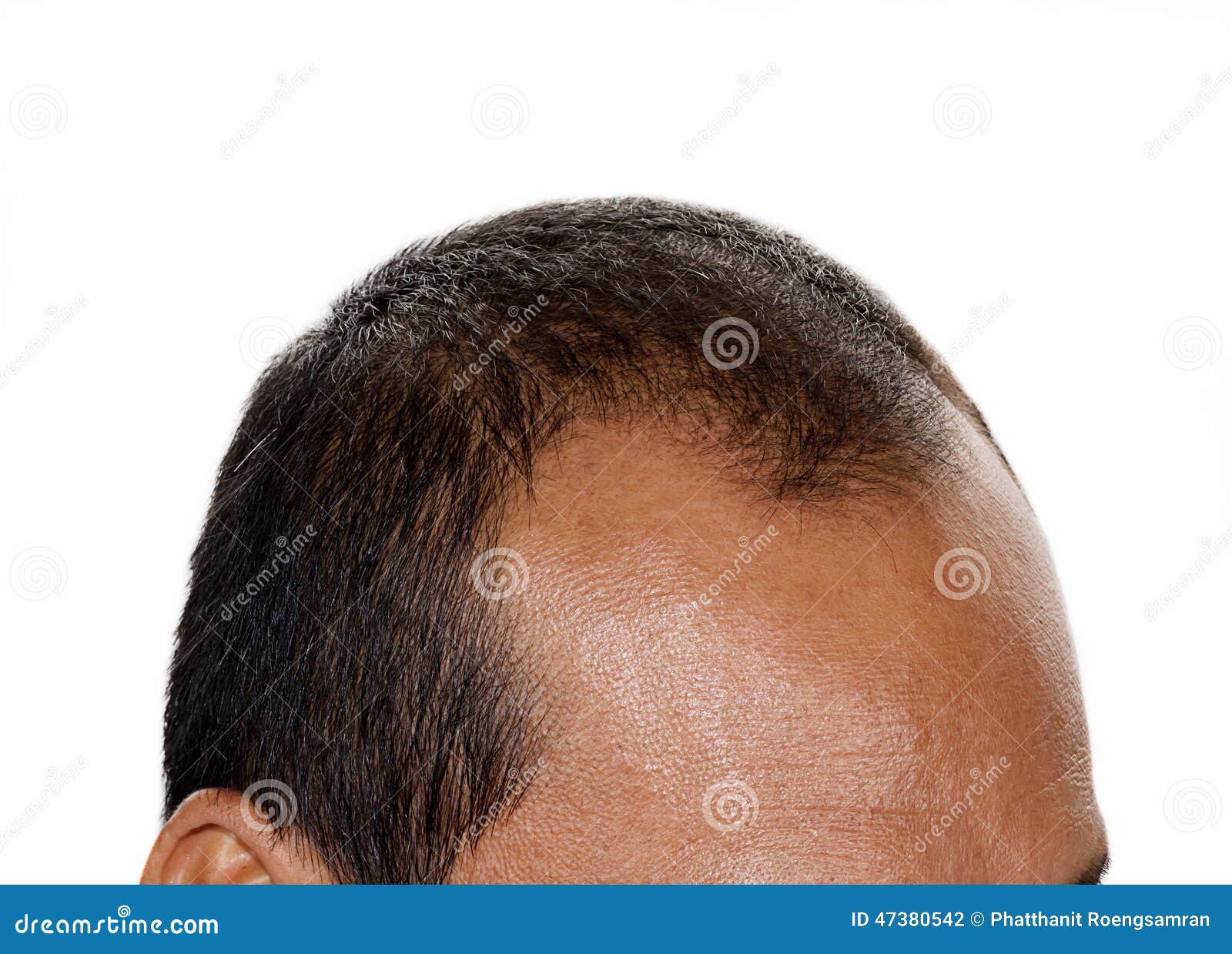 Hair loss , Male stock photo. Image of front, father 47380542