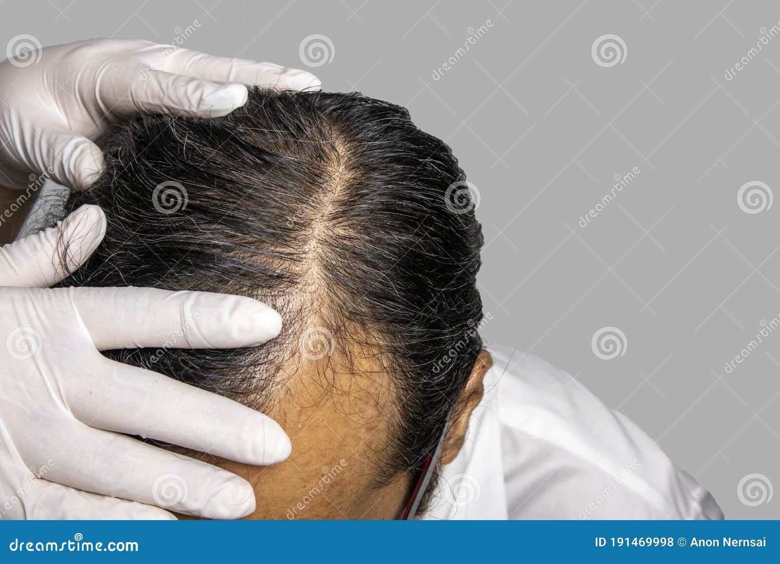 Hair Loss Specialist Wearing Gloves Use Both Hands on Head of a Man Stock  Photo - Image of glass, closeup: 191469998