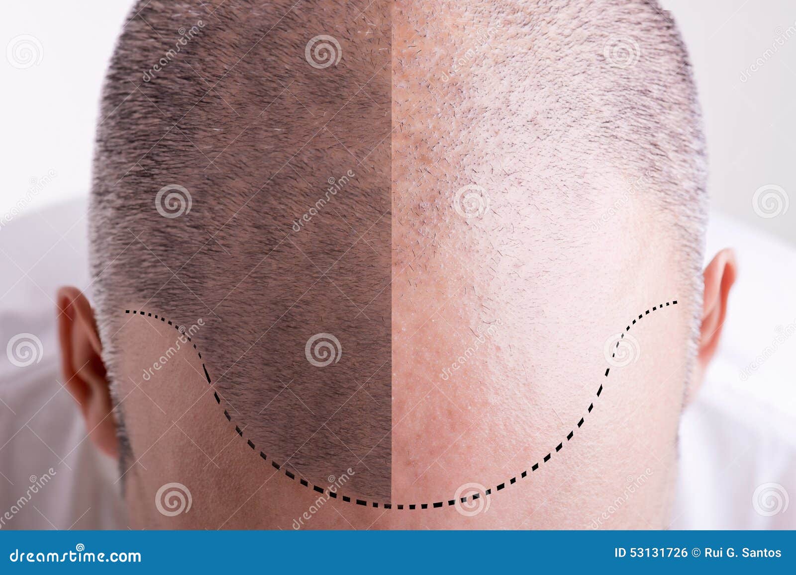 Hair Loss - before and after Stock Photo - Image of hairline, balding:  53131726