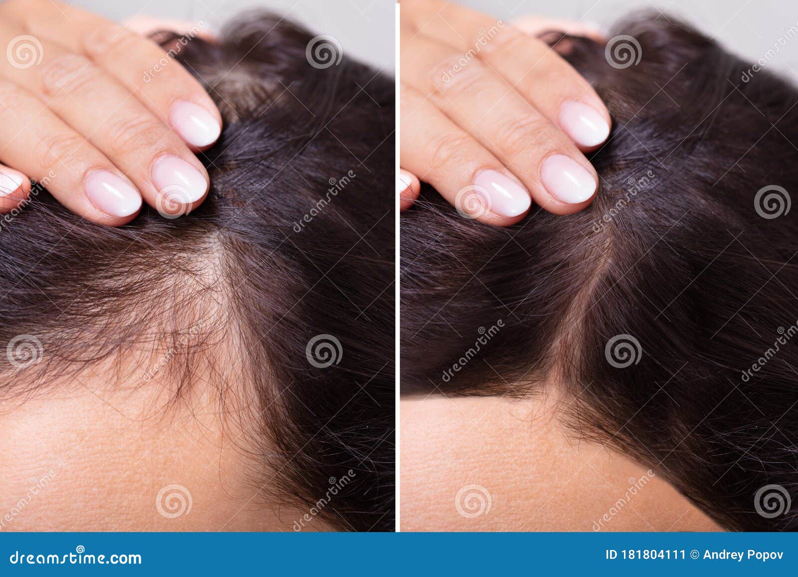 before and after hair loss treatment