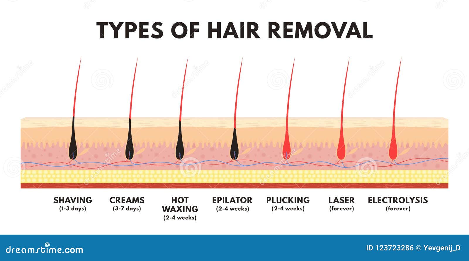 Bikini laser hair removal