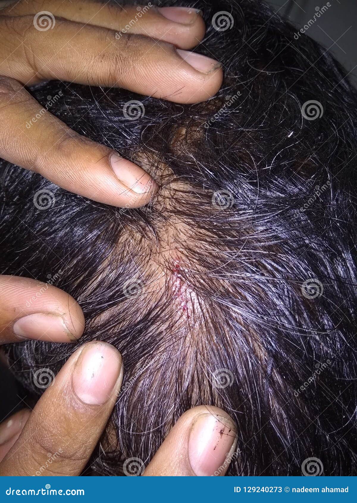 Hair removal stock image. Image of hair, head, friend 129240273