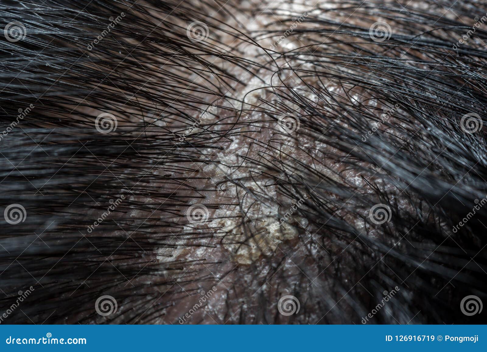 Hair Scalp with Dandruff and Scaly from Psoriasis Stock Image - Image of  background, annoying: 126916719