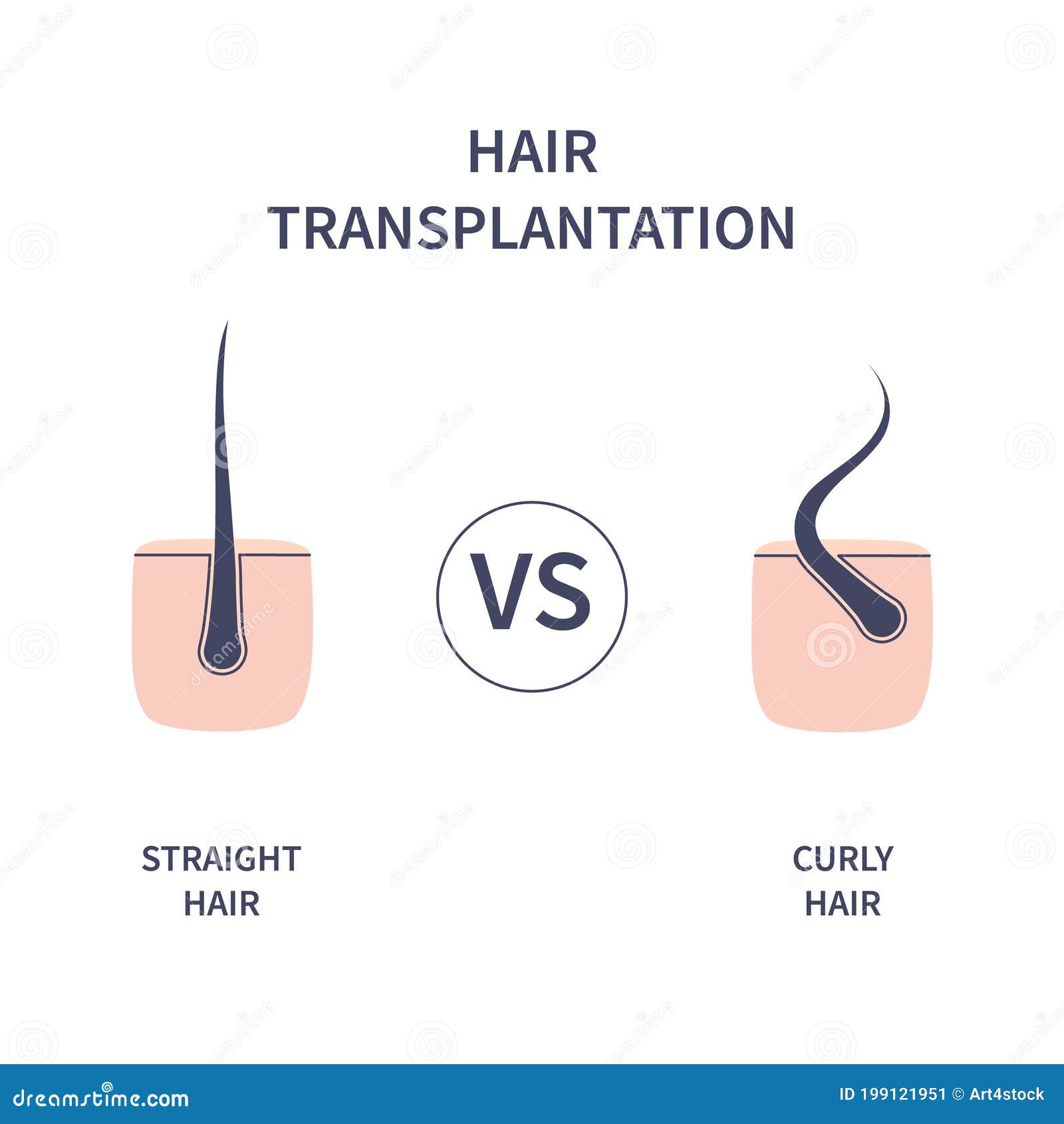 Hair Transplantation for Curly Versus Straight Hair Stock Vector -  Illustration of straight, alopecia: 199121951