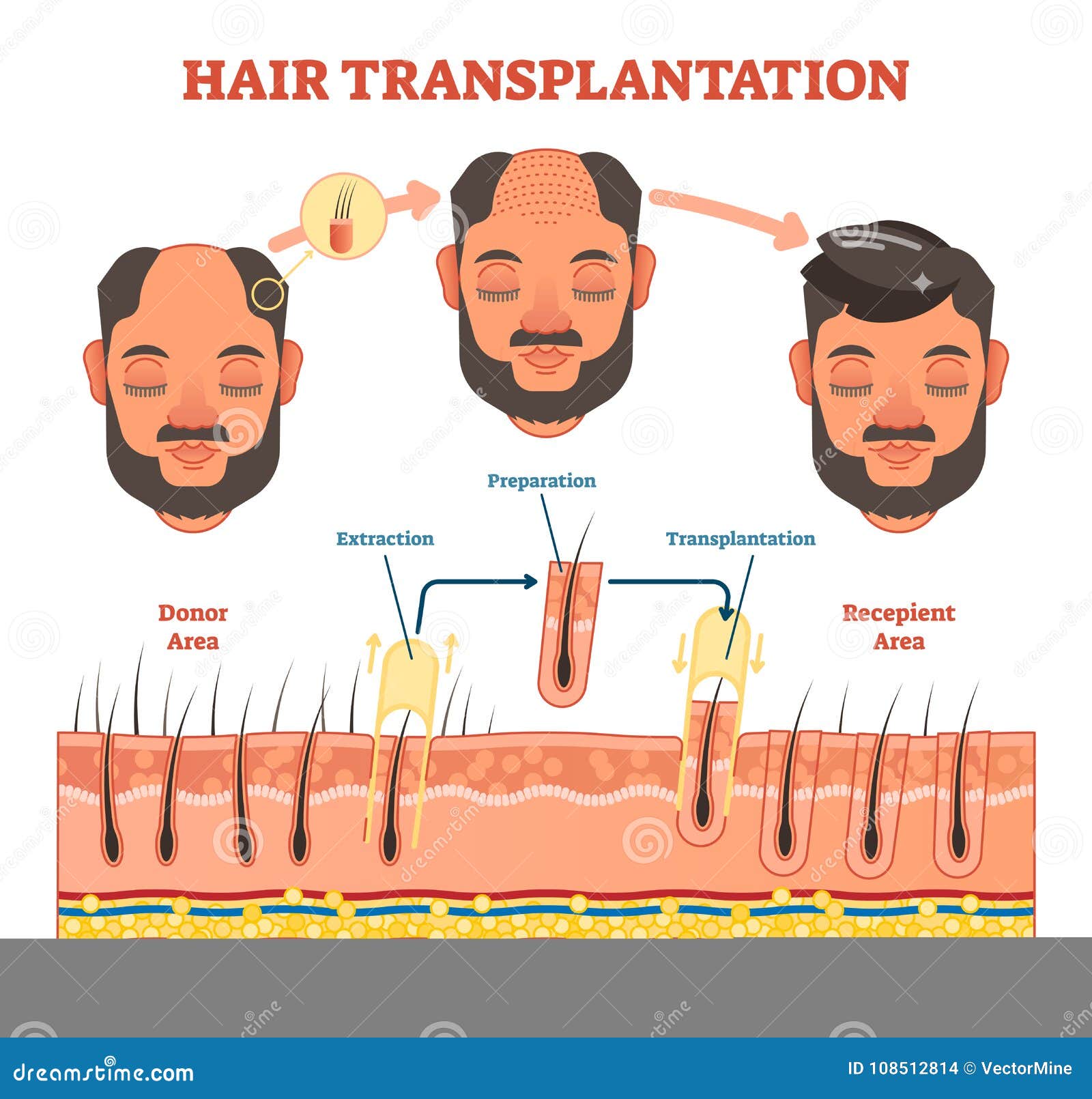 hair transplantation procedure diagram with steps