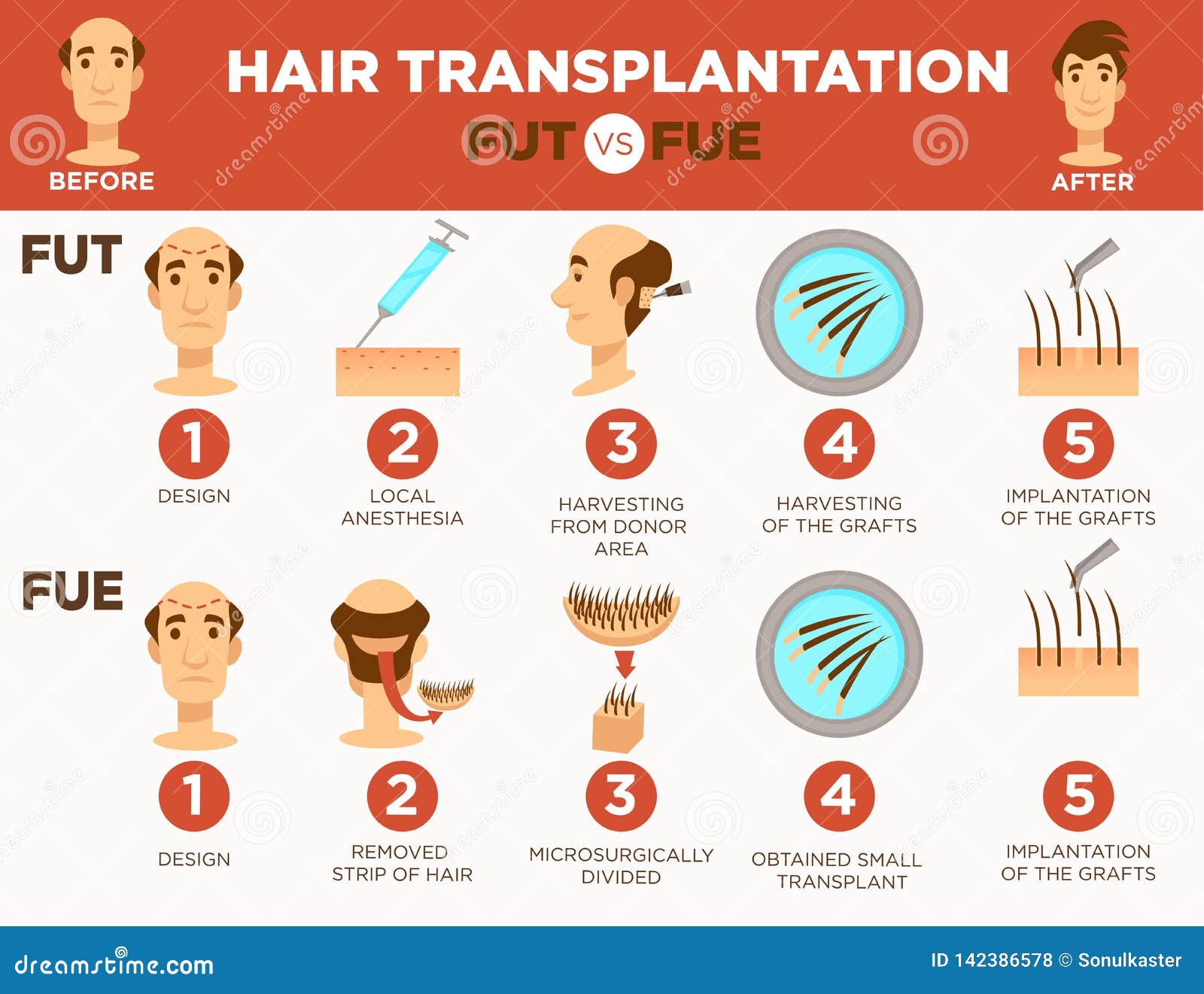 Hair Transplantation Surgery Cosmetic Procedure Bald Man Stock Vector -  Illustration of graft, implantation: 142386578