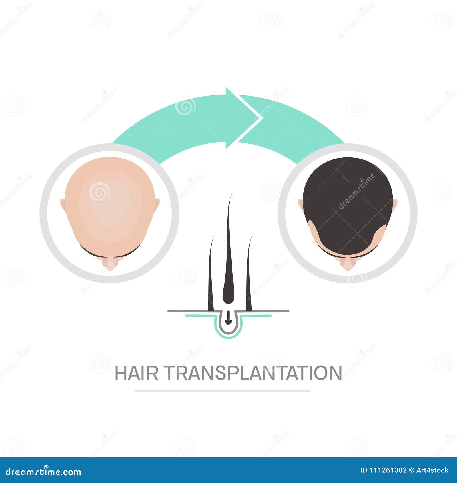 Hair Transplantation Poster Stock Vector - Illustration of progress, chart:  111261382