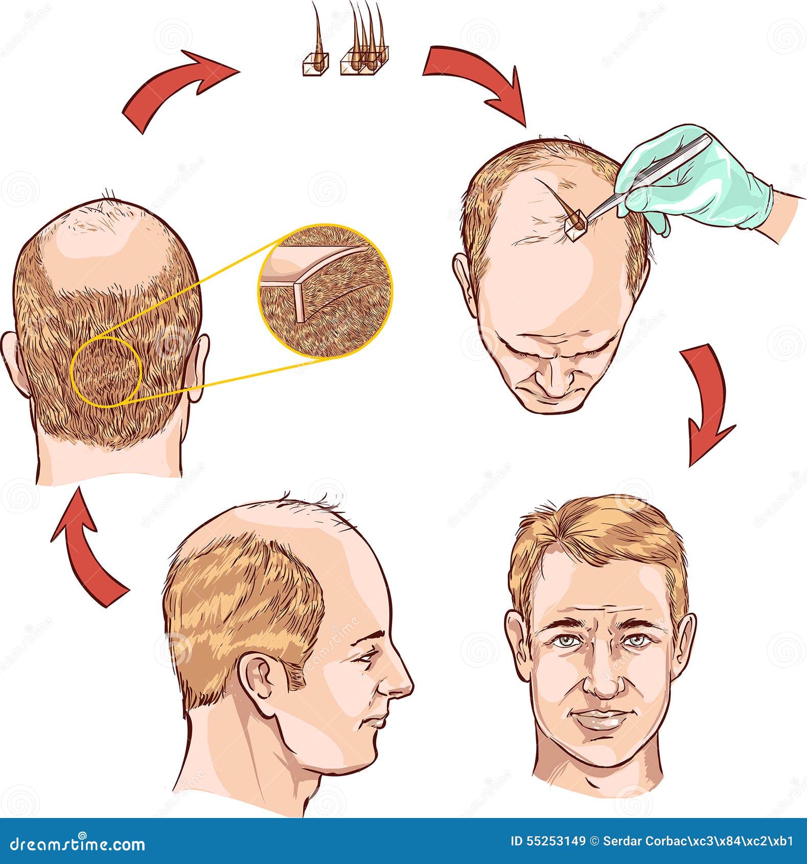 hair transplantation