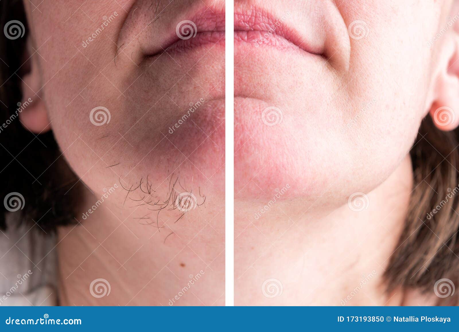 Hairs on Chin. Hair Removal on Face Stock Photo - Image of caucasian, chin:  173193850
