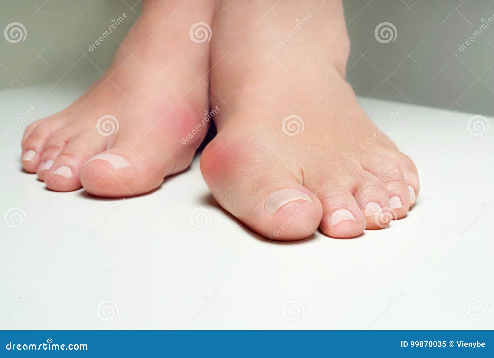Hallux Valgus 囊炎在白色背景的妇女脚库存图片 图片包括有 Hallux Valgus 囊炎在白色背景的妇女脚库存图片 图片包括有