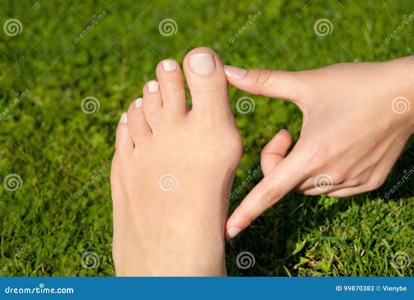 Hallux Valgus 囊炎在草背景的妇女脚库存图片 图片包括有valgus 囊炎在草背景的妇女脚
