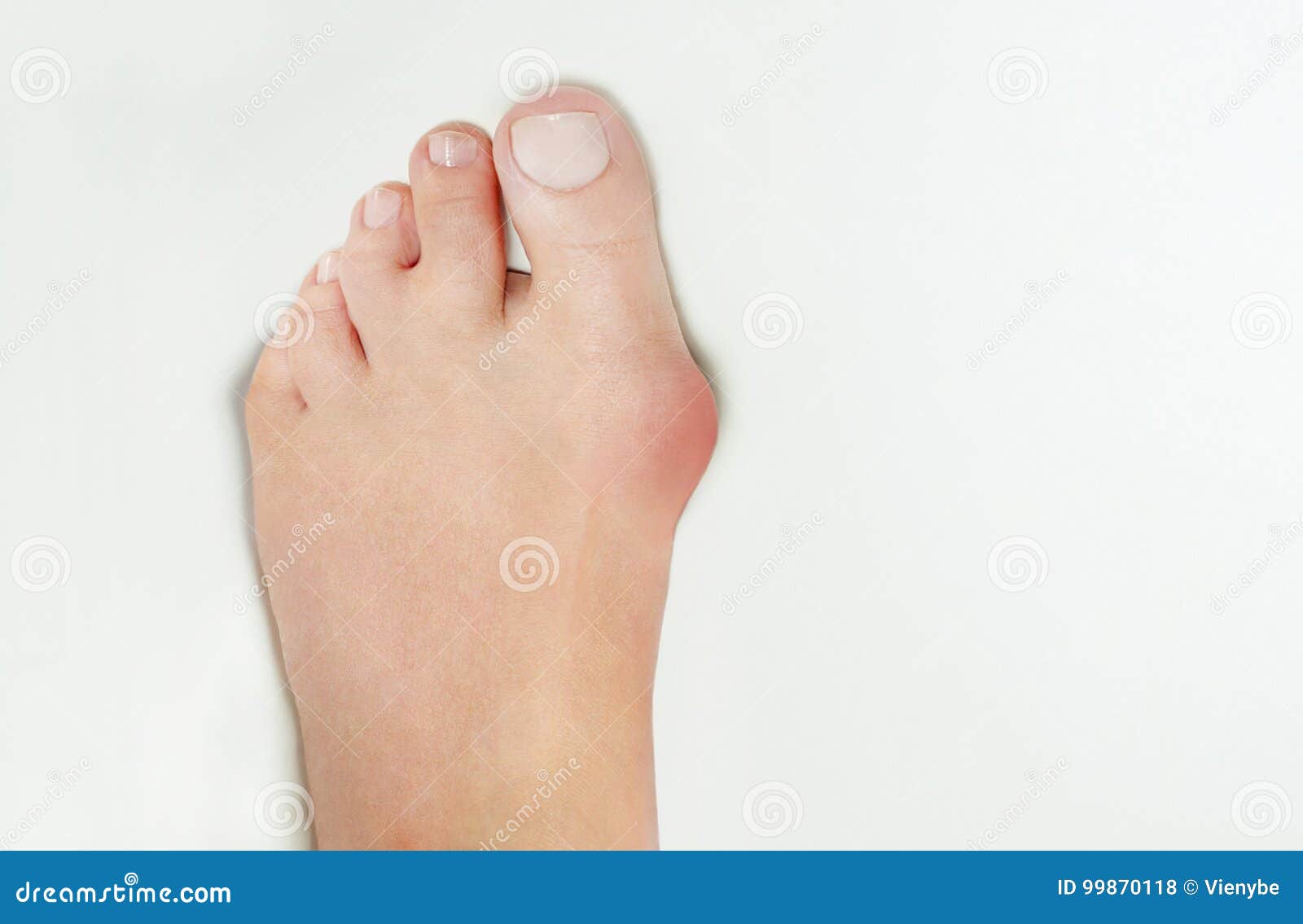 hallux valgus, bunion in woman foot on white background