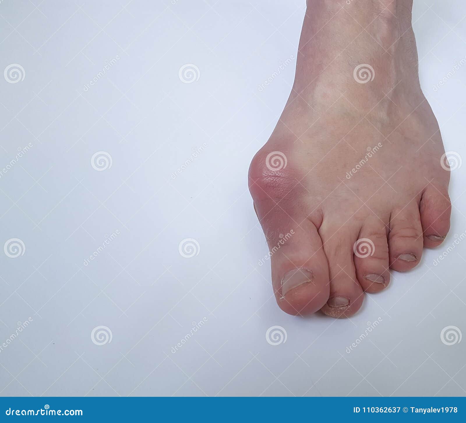 Hallux Valgus Deformity Of Feet