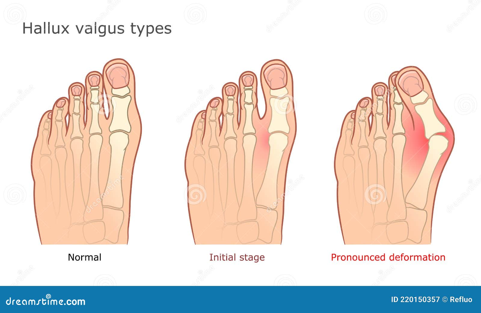Hallux Valgus Types Illustration Stock Vector - Illustration of ankle ...