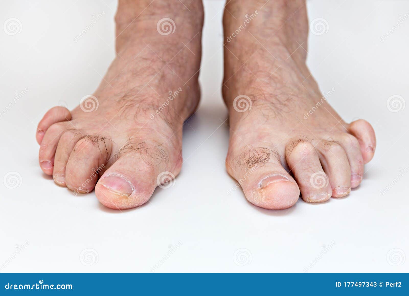 hammer toe feet