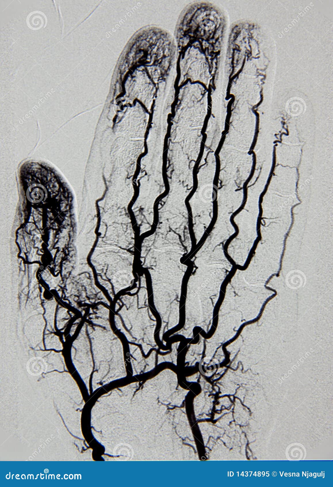 hand angiography, arteriography