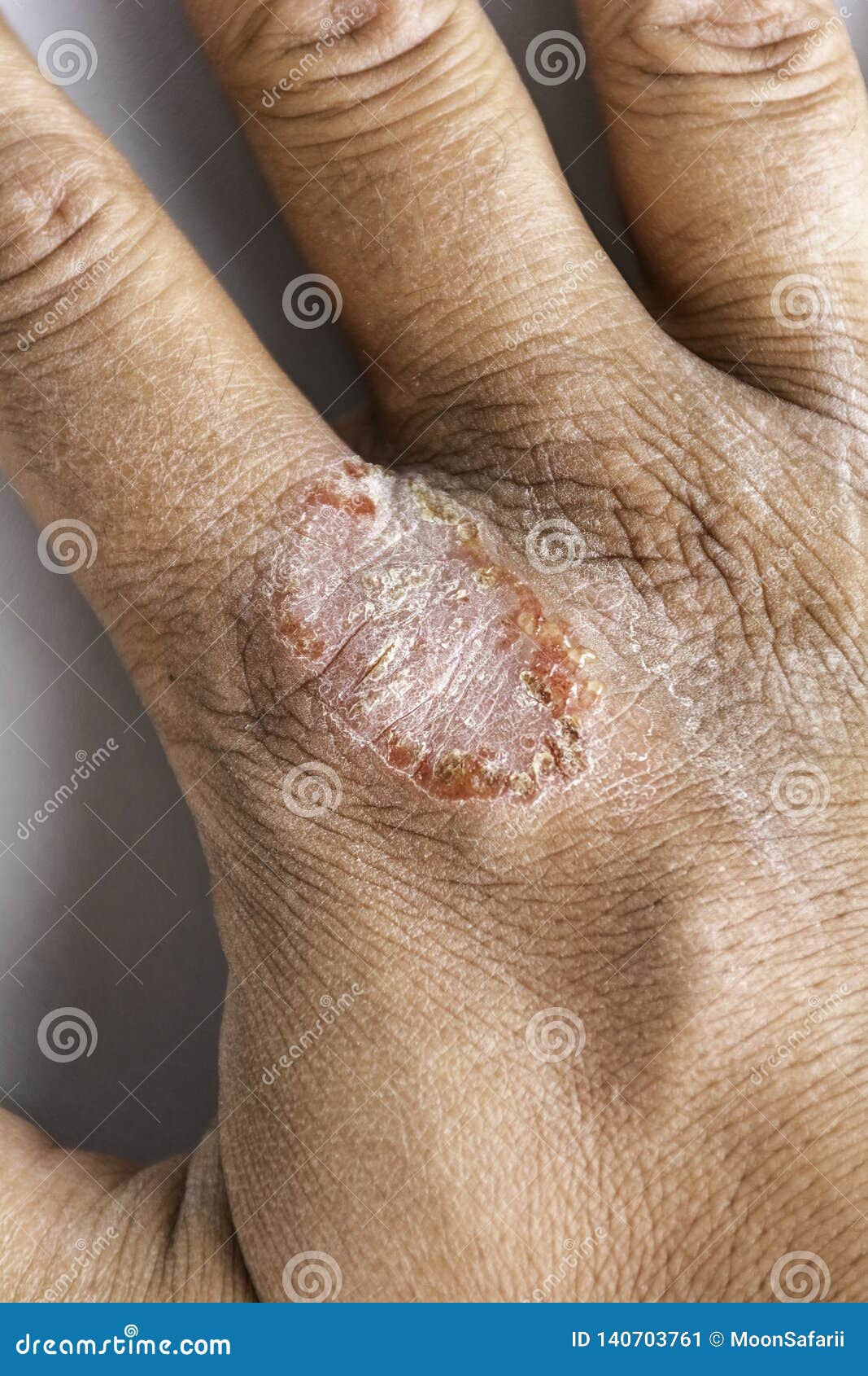Hand With Atopic Dermatitis Eczema Psoriasis Vulgaris Stock Image