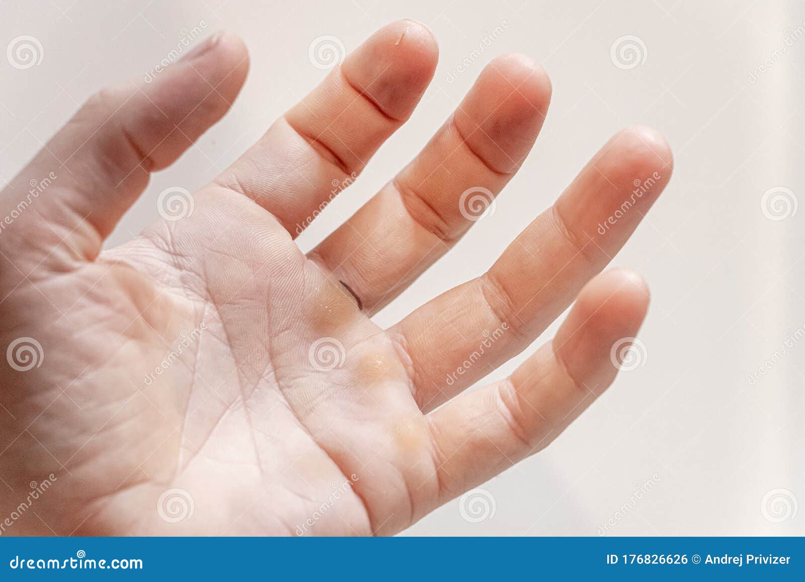 Hand with Blister and Callus on White Background Stock Photo Image of