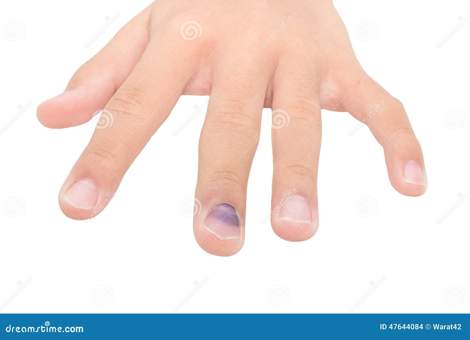 Hand with Bruised Nail, Isolated on White Background Stock Photo