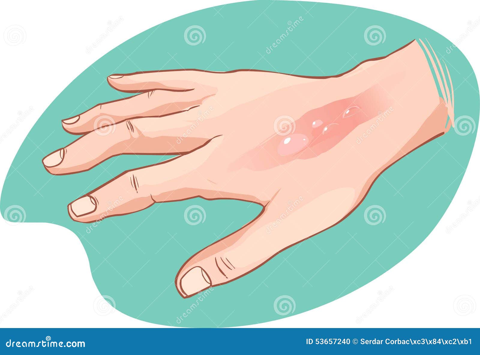 burn injury clipart