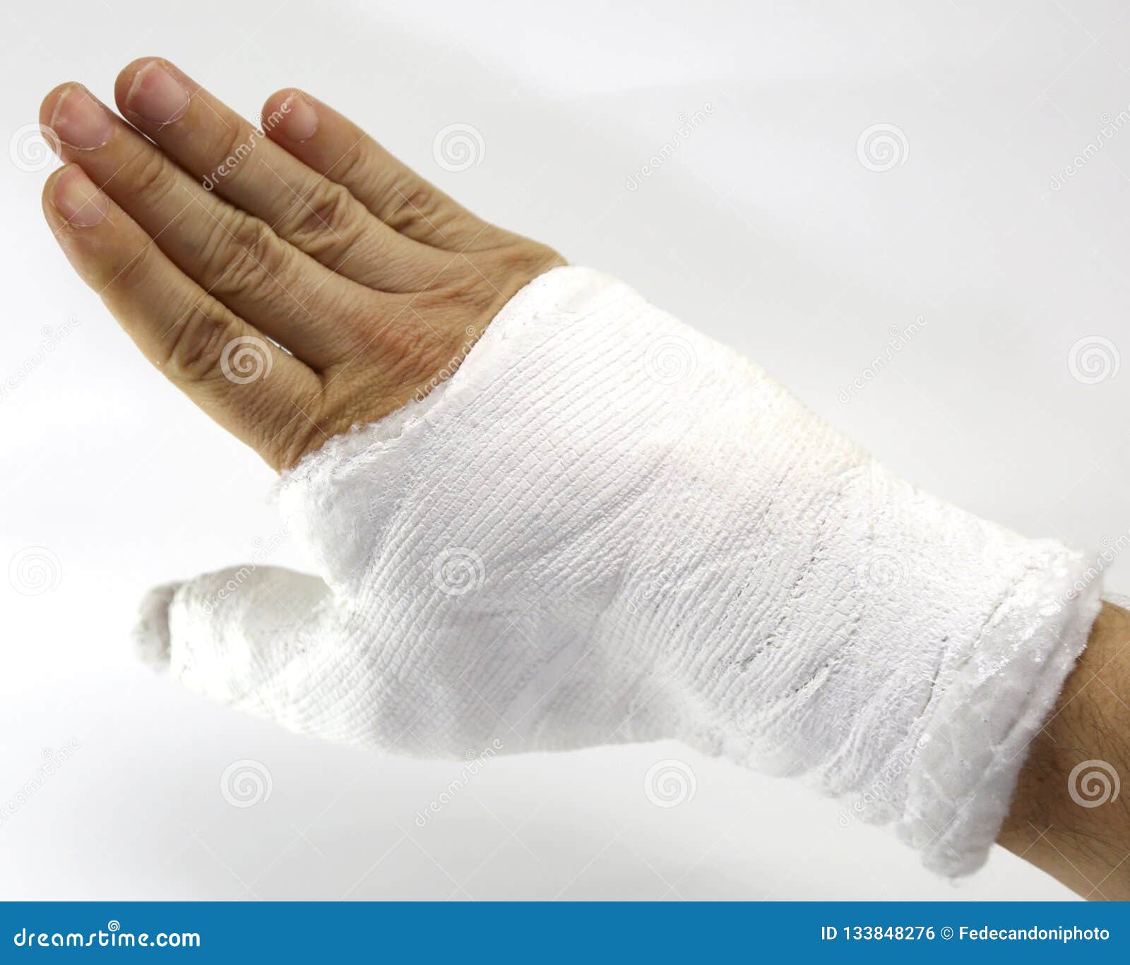 Hand Cast Fractured after an Accident Stock Photo - Image of hand