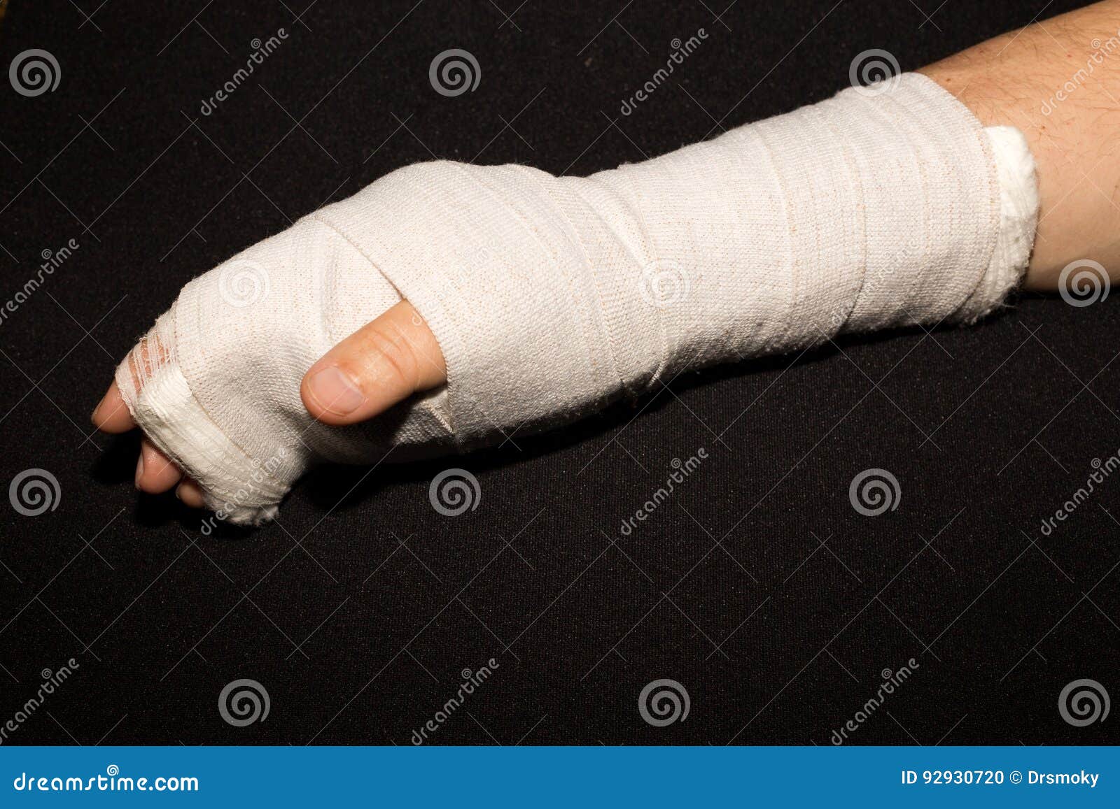 Hand in a cast. stock photo. Image of bone, joint, hand - 92930720