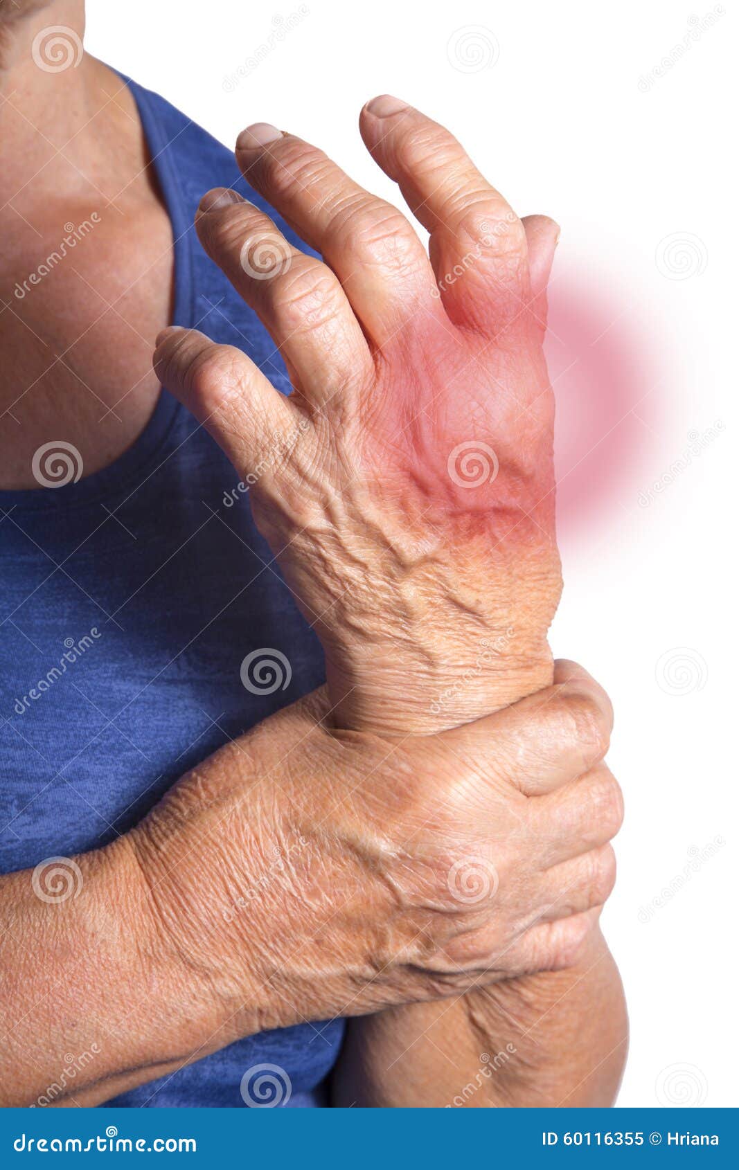 hand deformed from rheumatoid arthritis