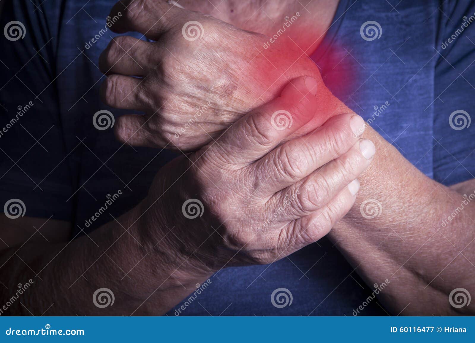 Hand Deformed from Rheumatoid Arthritis Stock Image Image of medical, rheumatoid 60116477